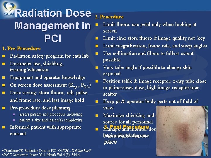 Radiation Dose Management in PCI 1. Pre-Procedure n Radiation safety program for cath lab