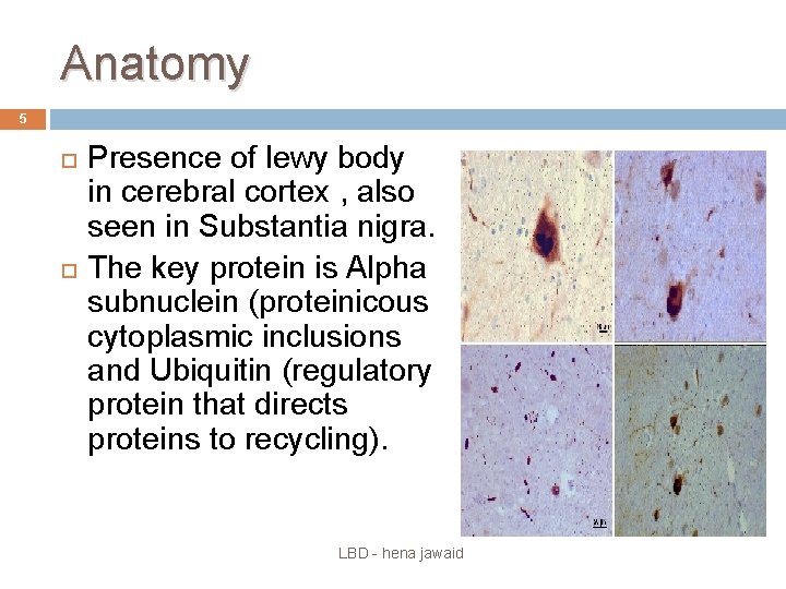 Anatomy 5 Presence of lewy body in cerebral cortex , also seen in Substantia