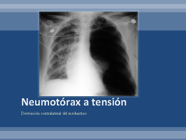 Neumotórax a tensión Desviación contralateral del mediastino 