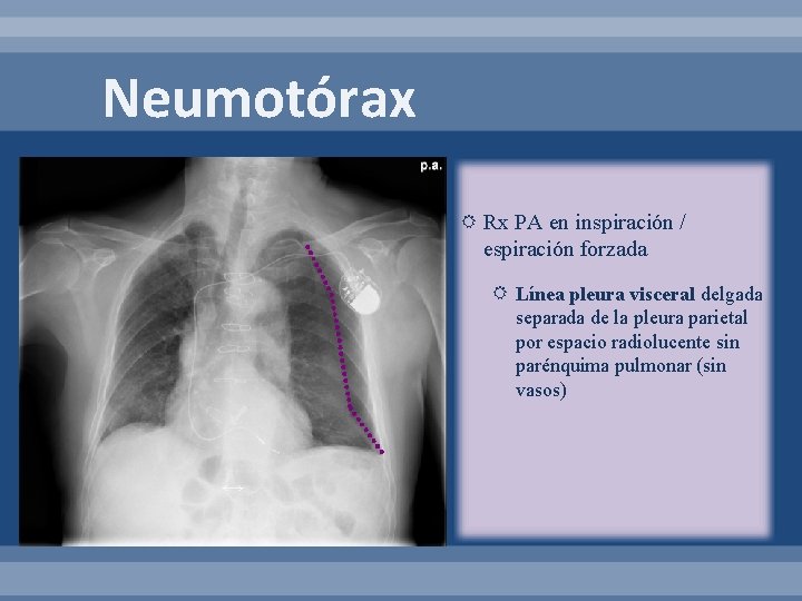 Neumotórax Rx PA en inspiración / espiración forzada Línea pleura visceral delgada separada de