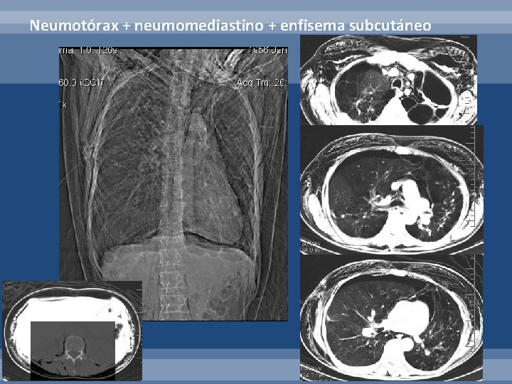 Neumotórax + neumomediastino + enfisema subcutáneo 
