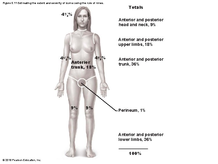 Figure 5. 11 Estimating the extent and severity of burns using the rule of