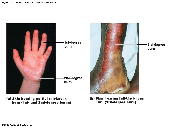 Figure 5. 12 Partial-thickness and full-thickness burns. 1 st-degree burn 3 rd-degree burn 2