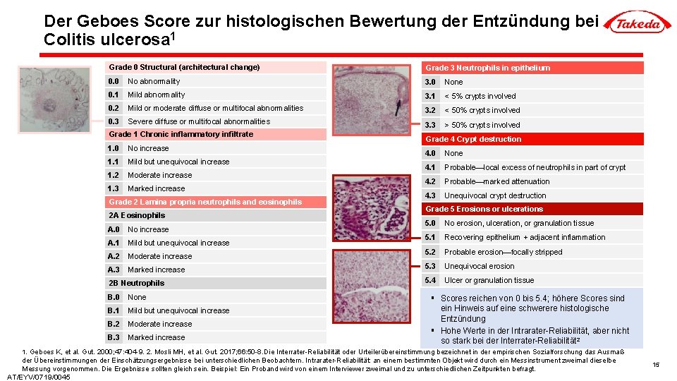 Der Geboes Score zur histologischen Bewertung der Entzündung bei Colitis ulcerosa 1 Grade 0
