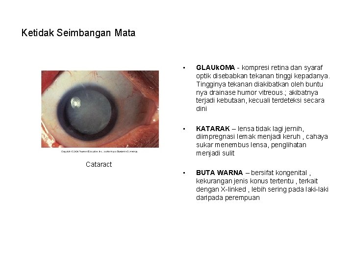 Ketidak Seimbangan Mata • GLAUk. OMA - kompresi retina dan syaraf optik disebabkan tekanan