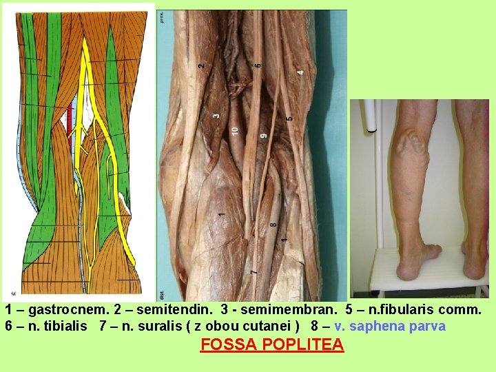 1 – gastrocnem. 2 – semitendin. 3 - semimembran. 5 – n. fibularis comm.