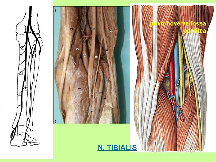 povrchově ve fossa poplitea N. TIBIALIS 