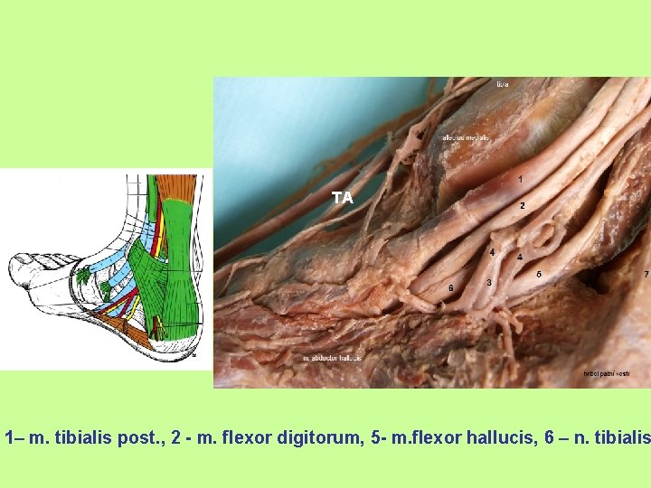 TA 1– m. tibialis post. , 2 - m. flexor digitorum, 5 - m.