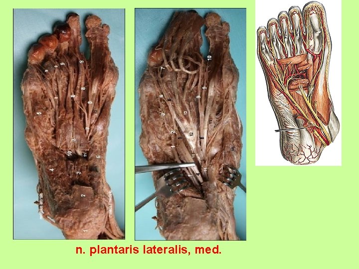 n. plantaris lateralis, med. 