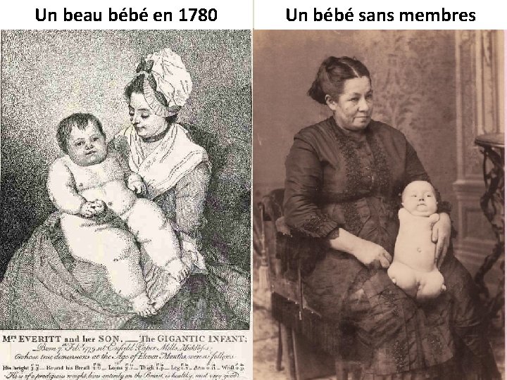 Un beau bébé en 1780 Un bébé sans membres 