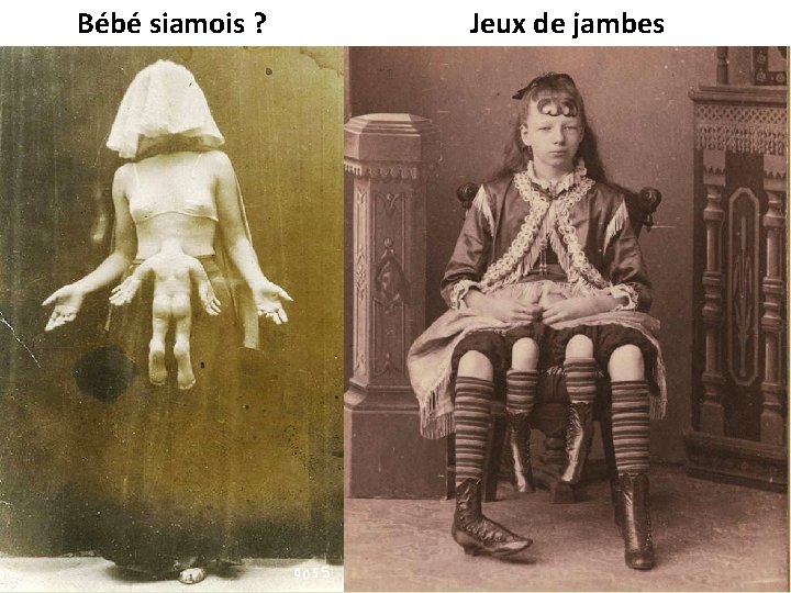 Bébé siamois ? Jeux de jambes 