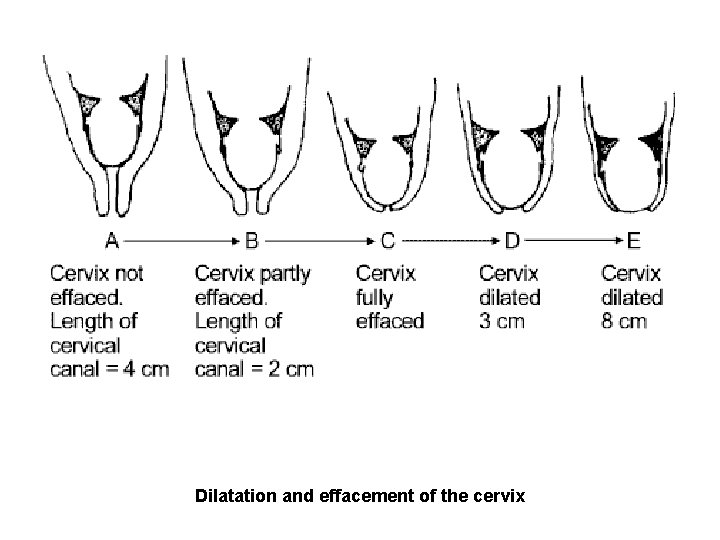 Dilatation and effacement of the cervix 
