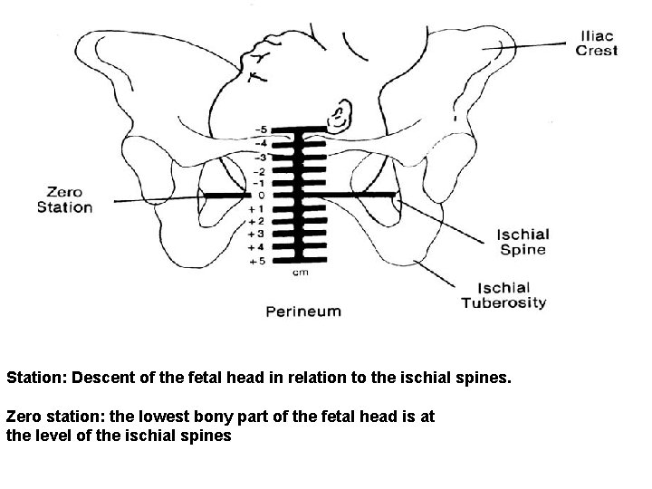 Station: Descent of the fetal head in relation to the ischial spines. Zero station: