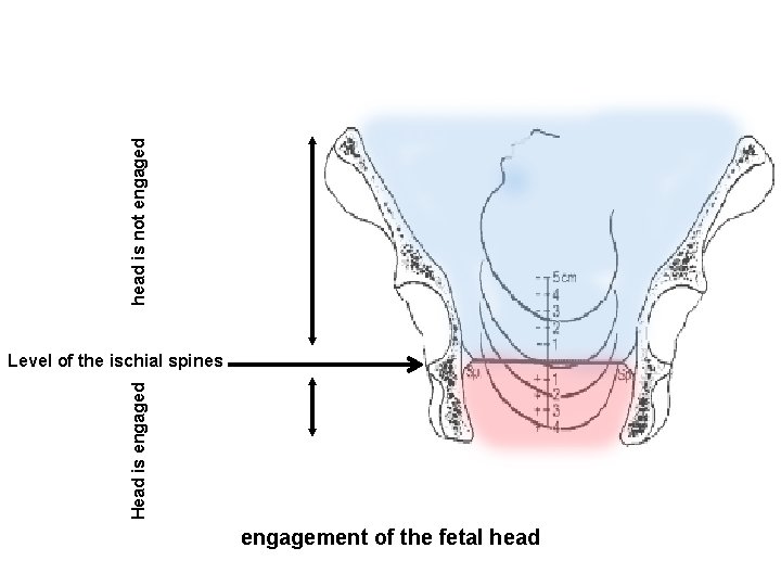 head is not engaged Head is engaged Level of the ischial spines engagement of