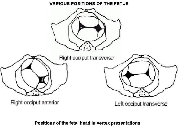 VARIOUS POSITIONS OF THE FETUS Positions of the fetal head in vertex presentations 