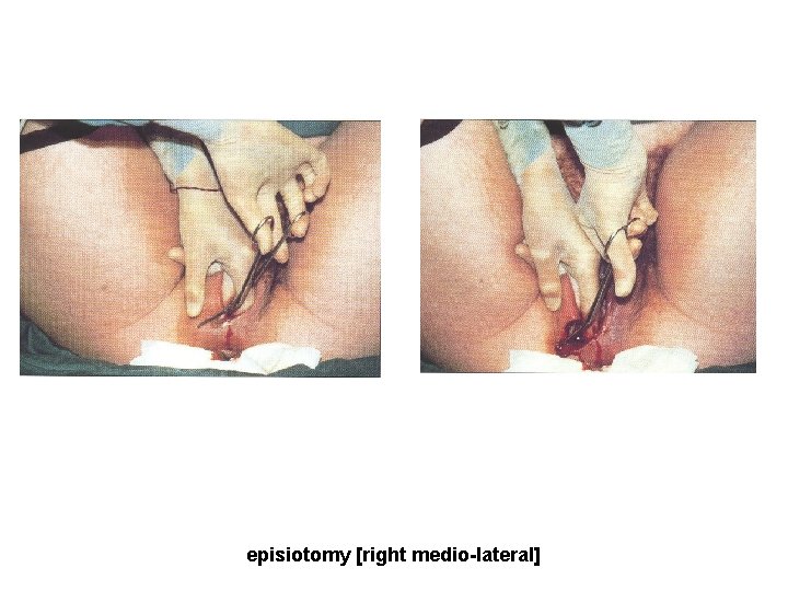 episiotomy [right medio-lateral] 
