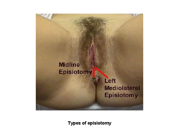 Types of episiotomy 