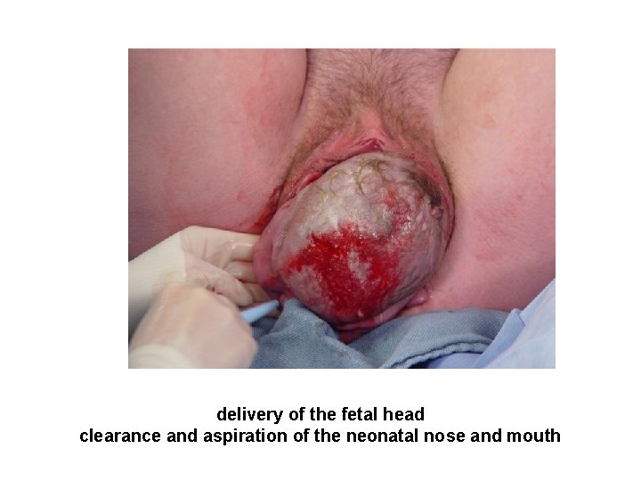 delivery of the fetal head clearance and aspiration of the neonatal nose and mouth