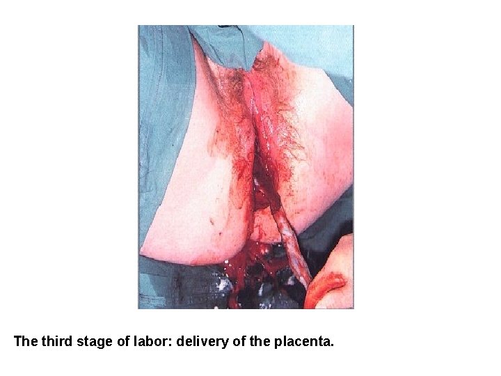 BREECH PRESENTATION The third stage of labor: delivery of the placenta. 