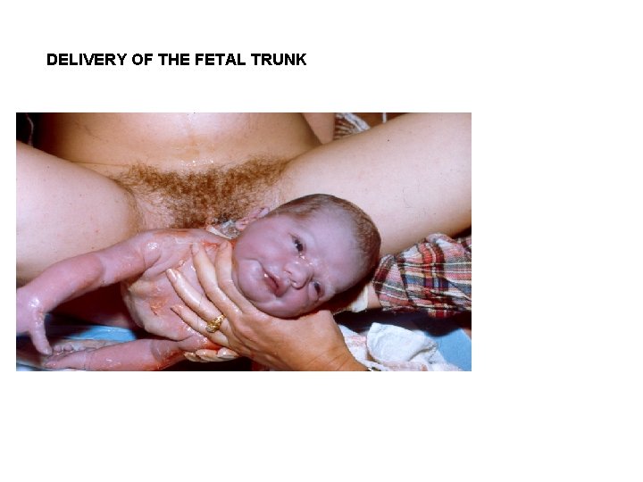 DELIVERY OF THE FETAL TRUNK 