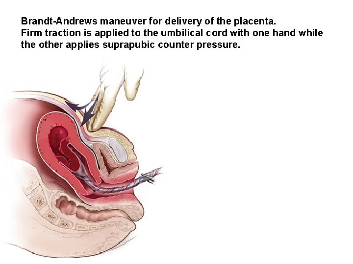 Brandt-Andrews maneuver for delivery of the placenta. Firm traction is applied to the umbilical