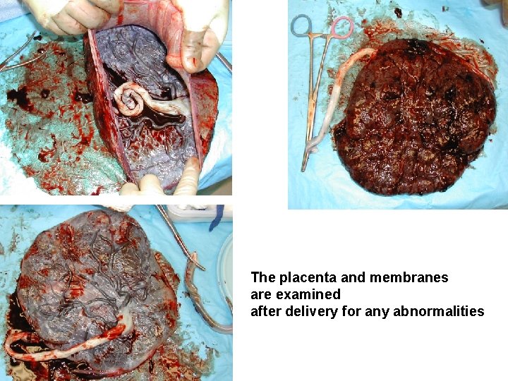 The placenta and membranes are examined after delivery for any abnormalities 