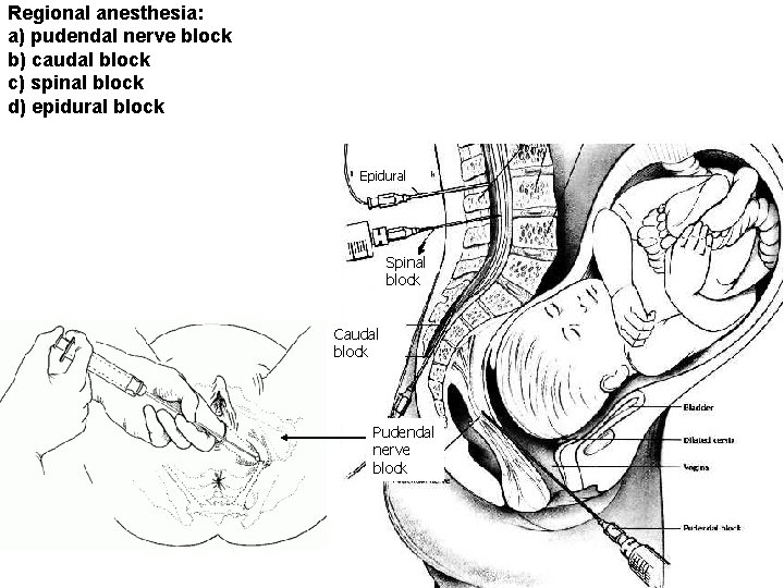 Regional anesthesia: a) pudendal nerve block b) caudal block c) spinal block d) epidural