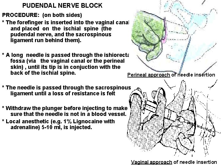 PUDENDAL NERVE BLOCK PROCEDURE: (on both sides) * The forefinger is inserted into the