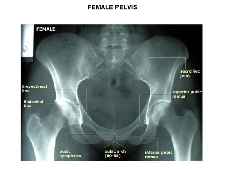 FEMALE PELVIS 