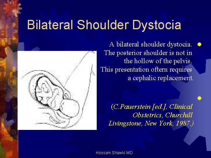 Bilateral Shoulder Dystocia A bilateral shoulder dystocia. ® The posterior shoulder is not in