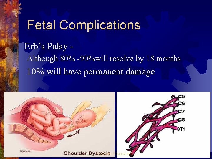 Fetal Complications Erb’s Palsy Although 80% -90%will resolve by 18 months 10% will have