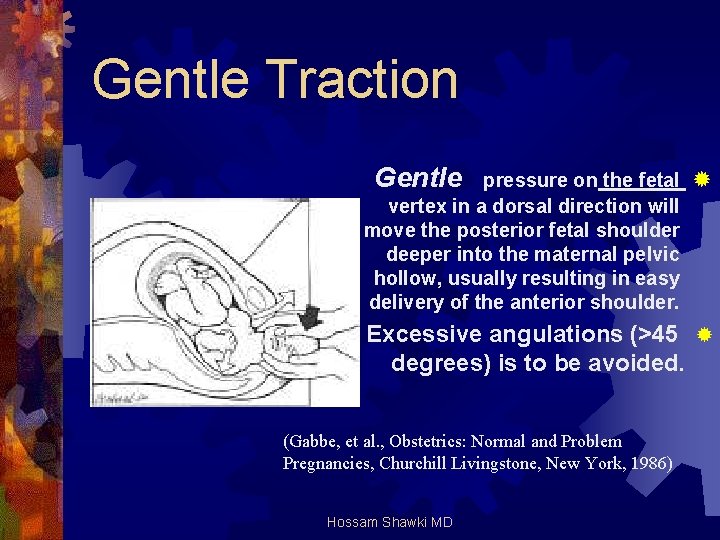Gentle Traction Gentle pressure on the fetal ® vertex in a dorsal direction will