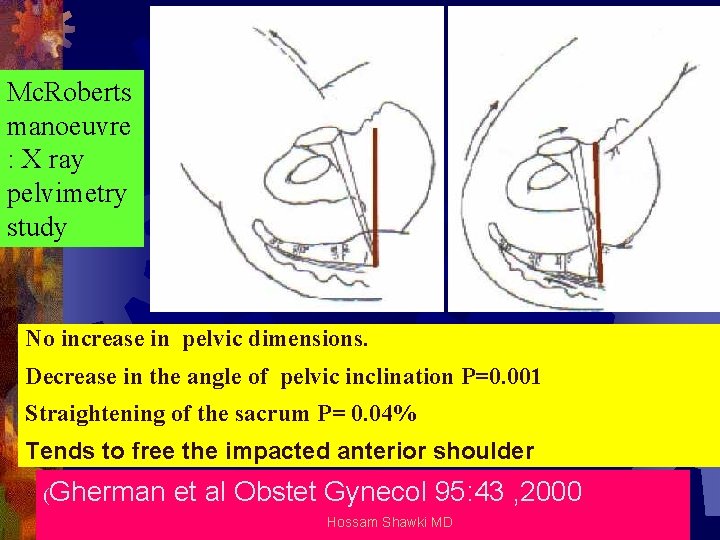 Mc. Roberts manoeuvre : X ray pelvimetry study No increase in pelvic dimensions. Decrease