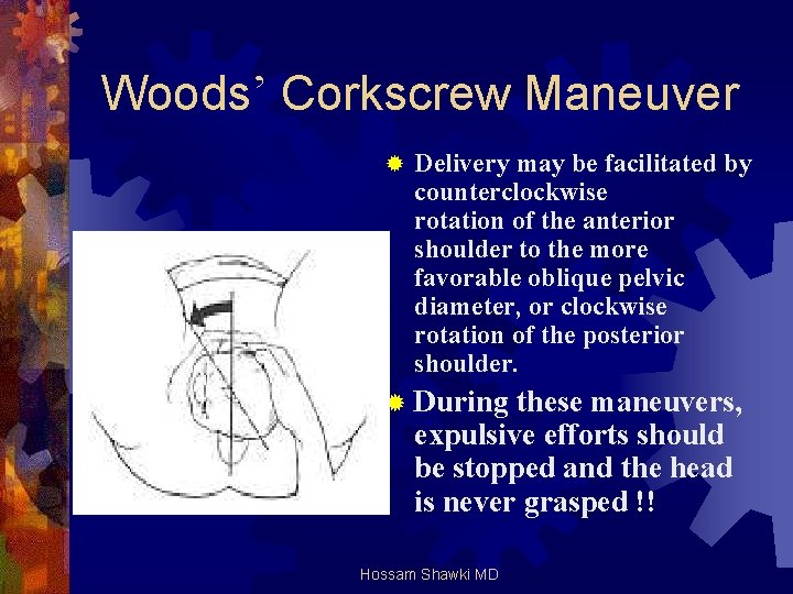 Woods’ Corkscrew Maneuver ® Delivery may be facilitated by counterclockwise rotation of the anterior