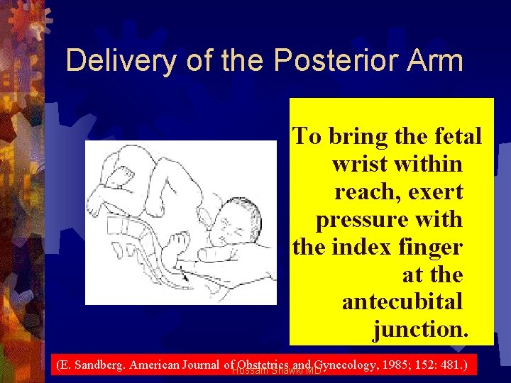Delivery of the Posterior Arm To bring the fetal wrist within reach, exert pressure