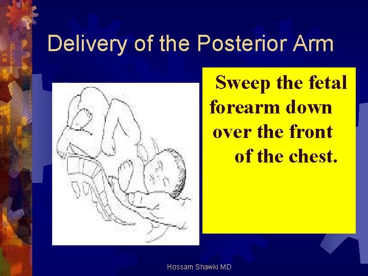 Delivery of the Posterior Arm Sweep the fetal forearm down over the front of