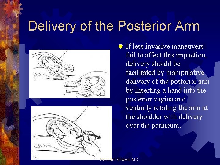 Delivery of the Posterior Arm ® If less invasive maneuvers fail to affect this
