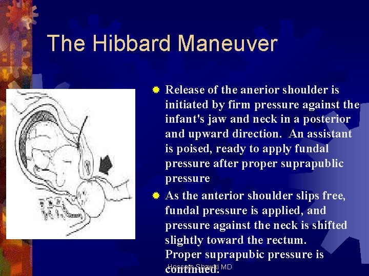 The Hibbard Maneuver Release of the anerior shoulder is initiated by firm pressure against