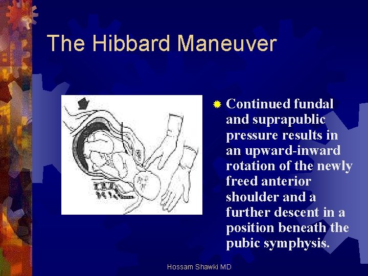 The Hibbard Maneuver ® Continued fundal and suprapublic pressure results in an upward-inward rotation