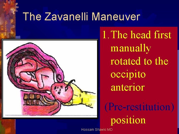 The Zavanelli Maneuver 1. The head first manually rotated to the occipito anterior (Pre-restitution)