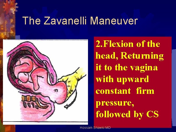 The Zavanelli Maneuver 2. Flexion of the head, Returning it to the vagina with