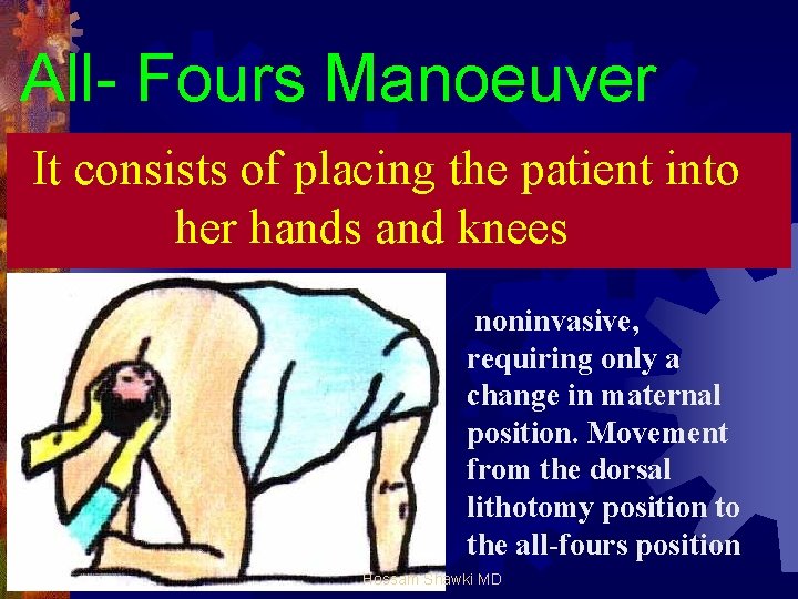 All- Fours Manoeuver It consists of placing the patient into her hands and knees