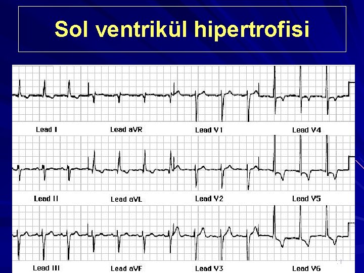 Sol ventrikül hipertrofisi 11 