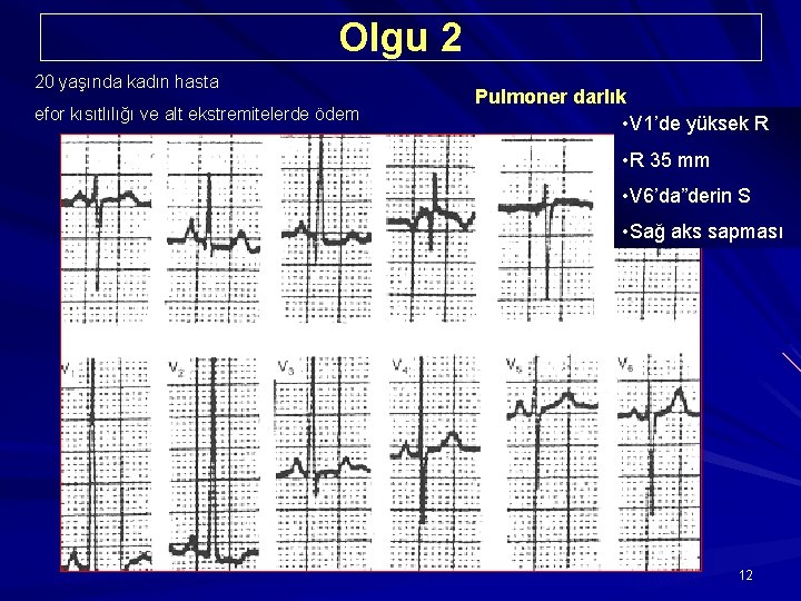 Olgu 2 20 yaşında kadın hasta efor kısıtlılığı ve alt ekstremitelerde ödem Pulmoner darlık