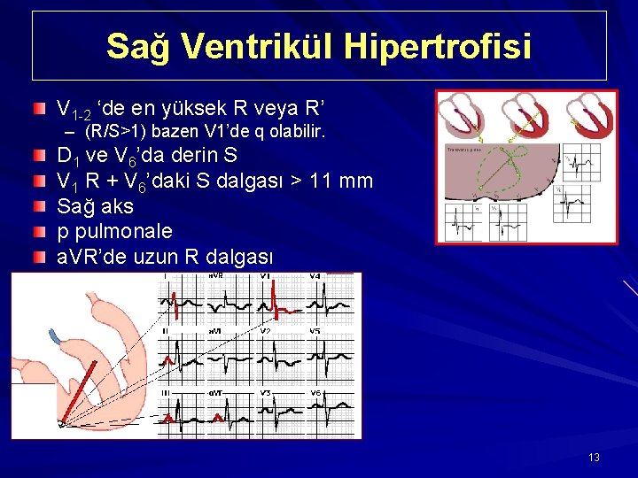 Sağ Ventrikül Hipertrofisi V 1 -2 ‘de en yüksek R veya R’ – (R/S>1)