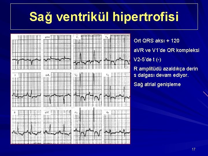 Sağ ventrikül hipertrofisi Ort QRS aksı + 120 a. VR ve V 1’de QR
