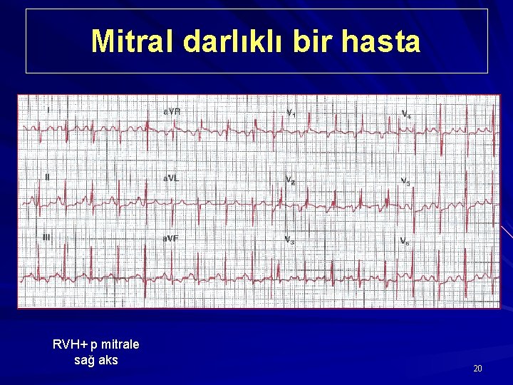 Mitral darlıklı bir hasta RVH+ p mitrale sağ aks 20 