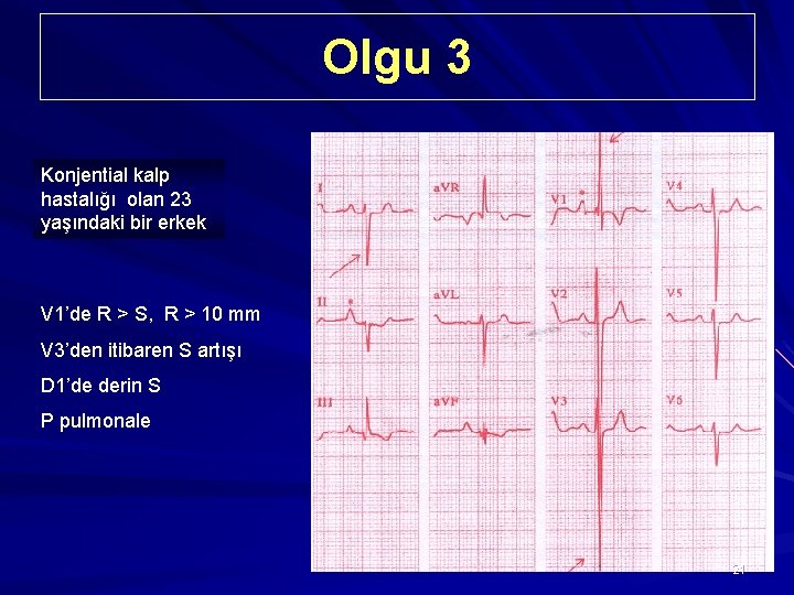 Olgu 3 Konjential kalp hastalığı olan 23 yaşındaki bir erkek V 1’de R >