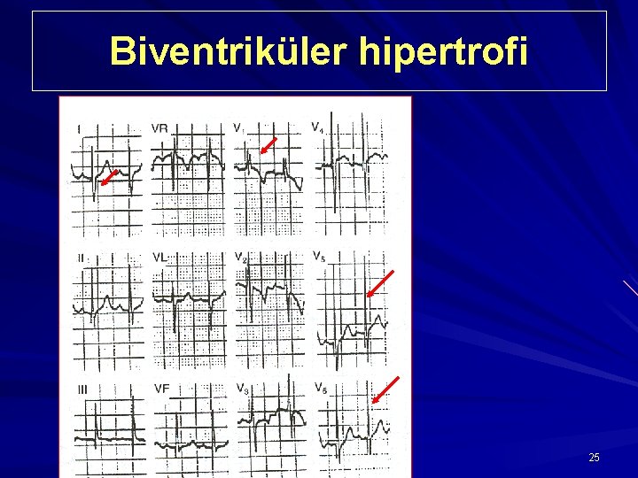 Biventriküler hipertrofi 25 