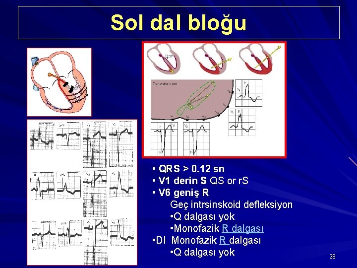 Sol dal bloğu • QRS > 0. 12 sn • V 1 derin S